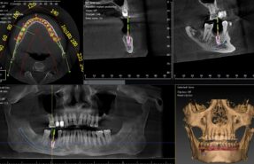 CBCT dentaire de nouvelle génération avec intelligence artificielle pour un diagnostic 3D de haute précision