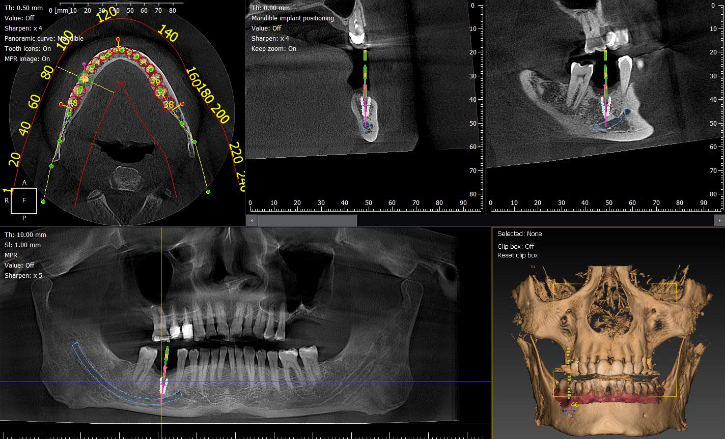 CBCT dentaire de nouvelle génération avec intelligence artificielle pour un diagnostic 3D de haute précision